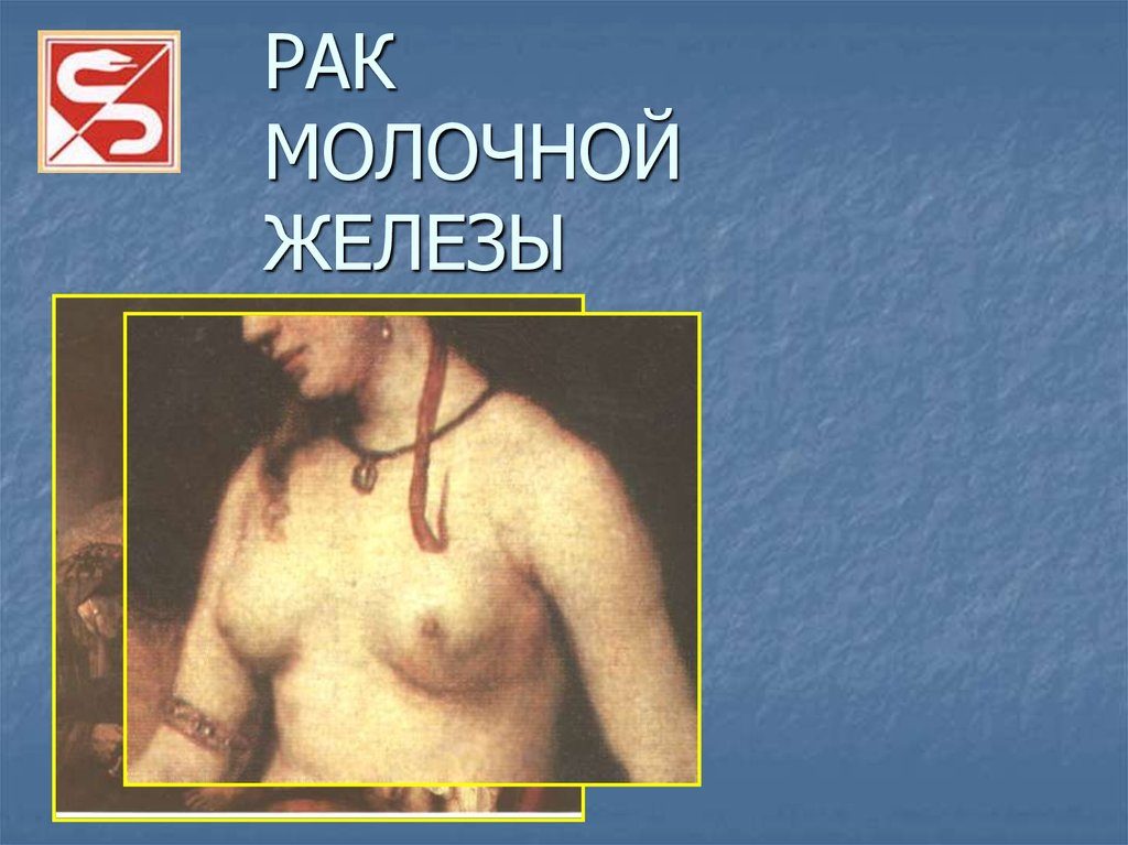 История болезни рак молочной железы