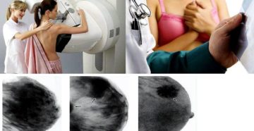 Маммография или узи молочных желез что лучше после 40 лет