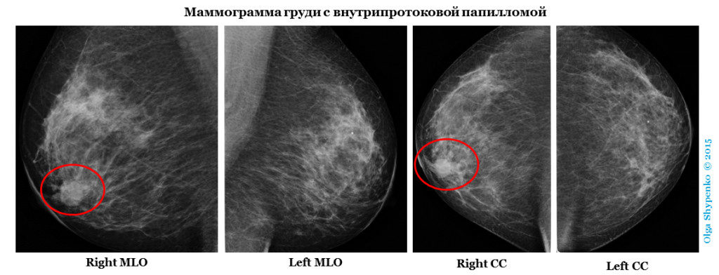 Цистаденопапиллома молочной железы