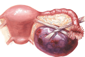 Опухоль на яичнике у женщин симптомы и операция