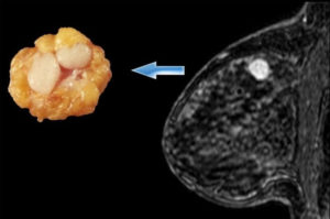 Может ли фиброаденома молочной железы перерасти в рак