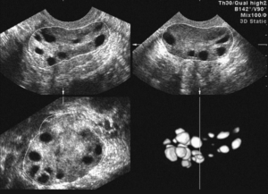 Диагностика поликистоза яичников