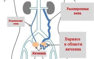 Варикозное расширение вен яичников