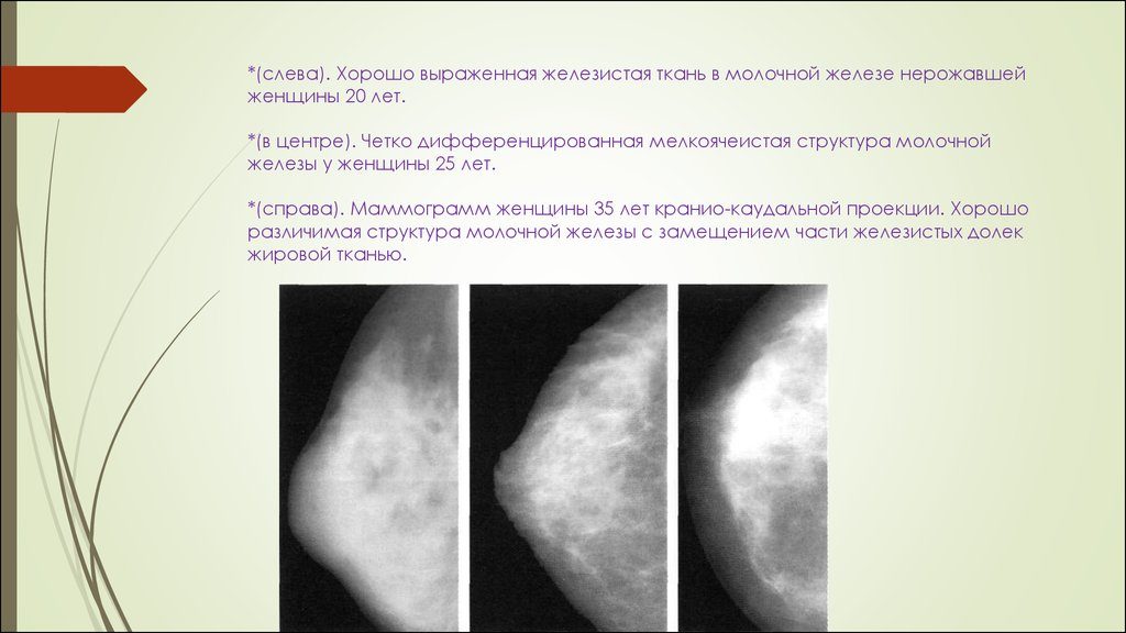 Железистая ткань молочной железы что это такое