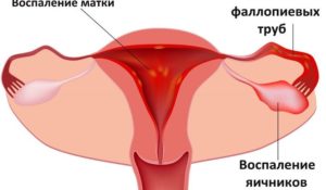 Болезни яичников у женщин перечень