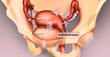 Эко и эндометриоз
