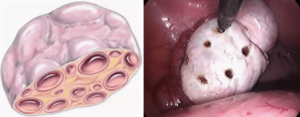 Лапароскопия поликистоз яичников