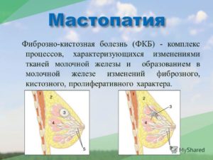 Фкм молочной железы что это такое как лечить