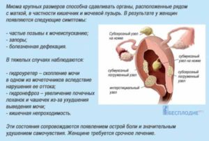 Симптомы миомы матки ранних стадиях