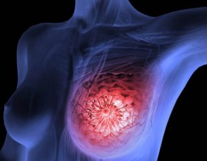 Онкология рак молочной железы