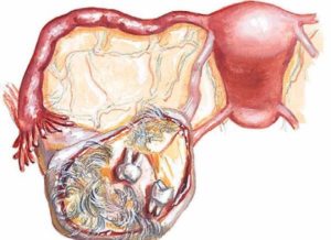 Киста яичника последствия после операции