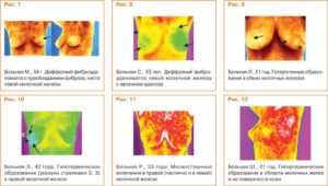 Фам молочной железы что это такое как лечить