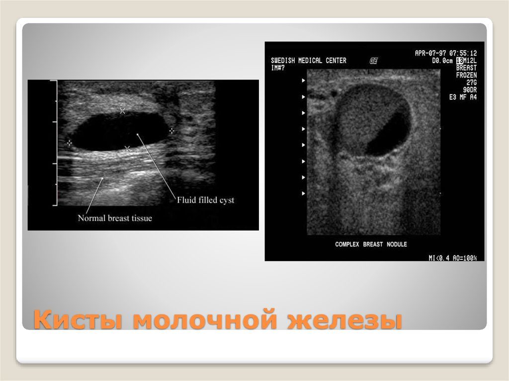 Протоковая киста молочной железы прогноз