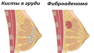 Болит киста в молочной железе