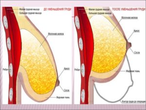 Уплотнение в молочной железе после прекращения кормления