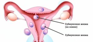 Субмукозная миома матки