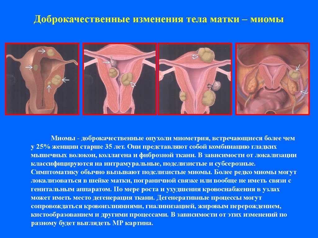 Миома тела матки что это такое