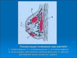 Интрамаммарный лимфоузел молочной железы причины возникновения