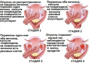 Признаки рака яичника на ранней стадии у женщин