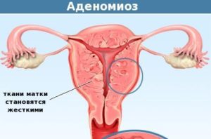 Миома матки малых размеров в сочетании с аденомиозом