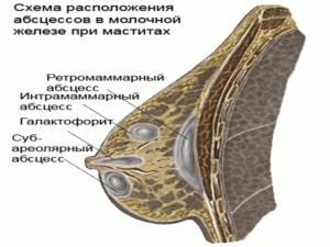 Абсцесс молочной железы