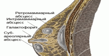 Абсцесс молочной железы. Гнойник на грудной железе. Абсцесс соска молочной железы. Флегмона молочной железы.