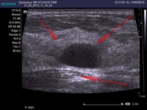 Когда нужно делать узи молочной железы