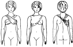 Косыночная повязка на молочную железу