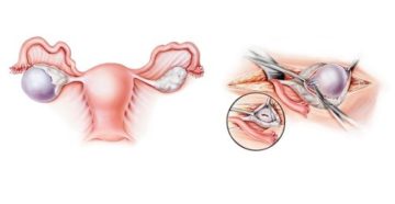 Киста яичника после менопаузы