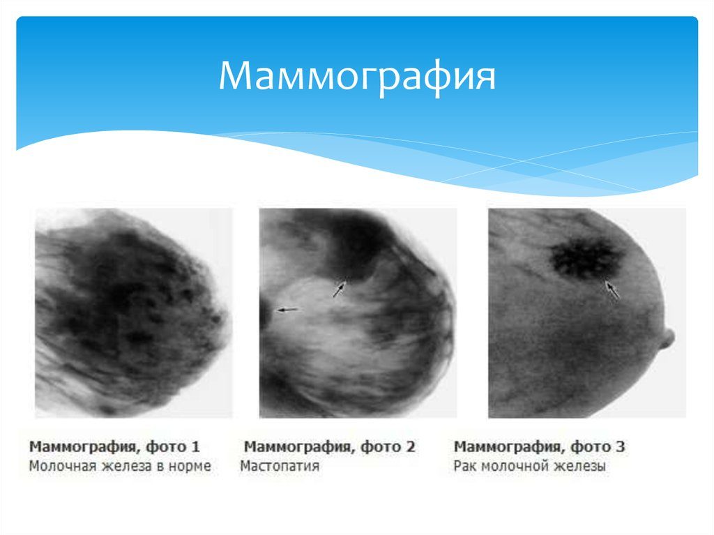 В какой период делают маммографию молочных желез