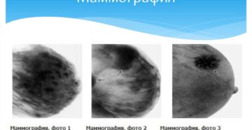 В какой период делают маммографию молочных желез