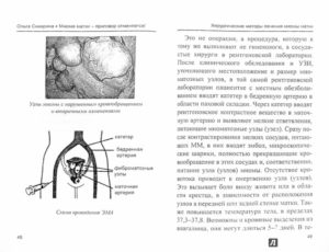 Миома после 50 лет лечение