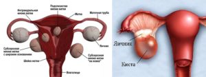 Симптомы миомы матки и кисты яичника