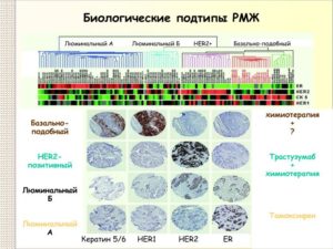 Люминальный а тип рака молочной железы