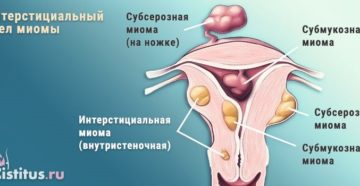 Интерстициальная миома матки