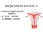 Интерстициальная миома тела матки