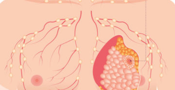 От чего бывает рак молочной железы