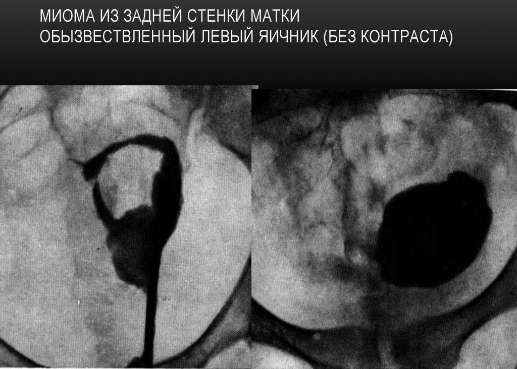 Миома матки на задней стенке