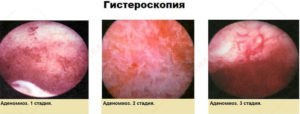 Эндометриоз внутренний диффузная форма