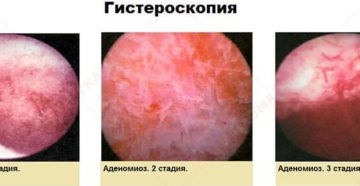 Эндометриоз внутренний диффузная форма