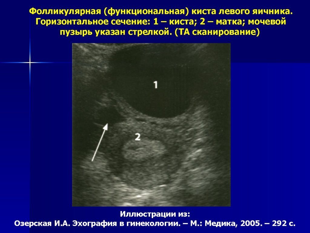 Функциональная киста правого яичника лечение