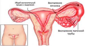 Уколы при воспалении придатков и яичников у женщин
