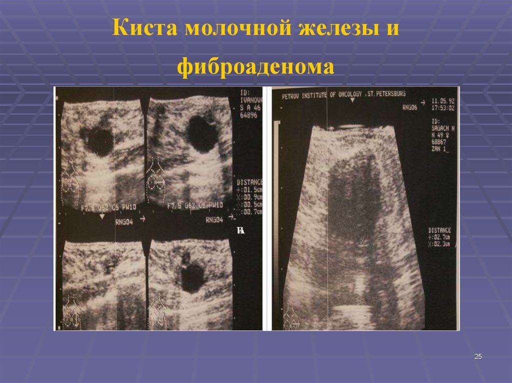 Чем отличается фиброаденома от кисты молочной железы