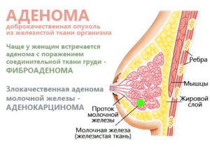 Аденома молочной железы что такое