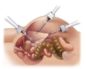 Операция полостная по удалению матки и яичников