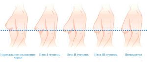 Псевдоптоз молочных желез