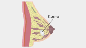 Что такое киста в молочной железе и чем она опасна