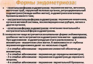 Как лечить эндометриоз матки медикаментозно