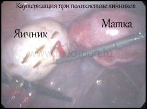 Беременность при поликистозе яичников после лапароскопии