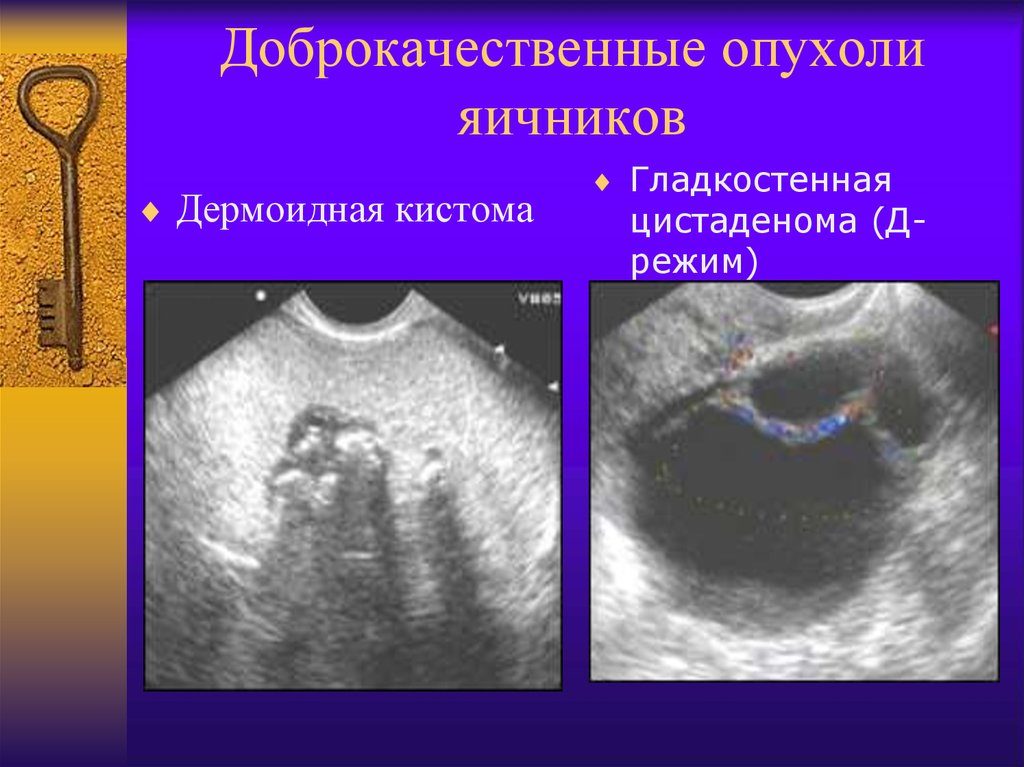 Доброкачественные опухоли яичников клинические рекомендации